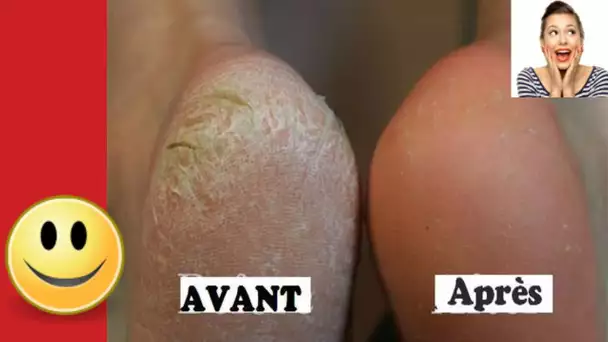 Voici comment se débarrasser rapidement des pieds secs et fendillés d&#039;une façon naturelle