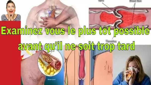 vous avez un caillot de sang ?! Examinez vous le plus tôt possible avant qu’il ne soit trop tard