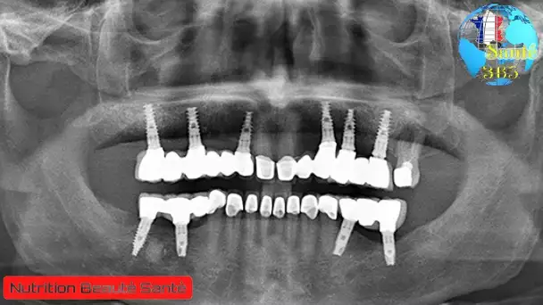 Dites Adieu aux implants dentaires, et faites pousser vos propres dents en seulement 9 semaines !