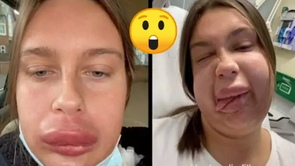 Une femme fait une grave réaction allergique après une opération des lèvres