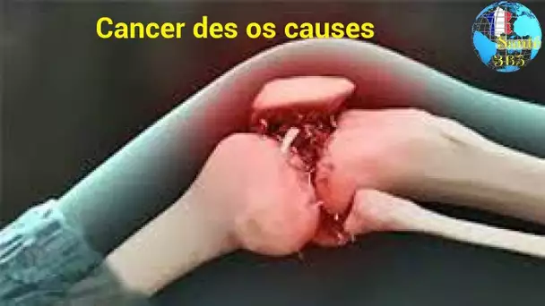 Cancer des os causes