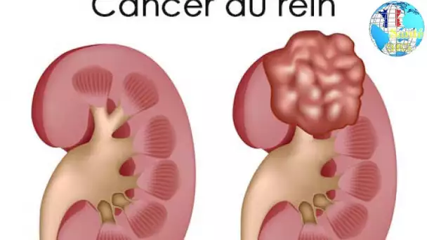 Cancer du rein symptômes