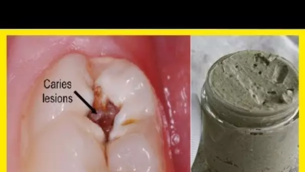 Il soigne les caries, les maladies des gencives et blanchit les dents naturellement … Ce Dentifrice
