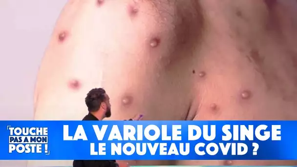 La variole du singe peut-elle être le nouveau covid ?