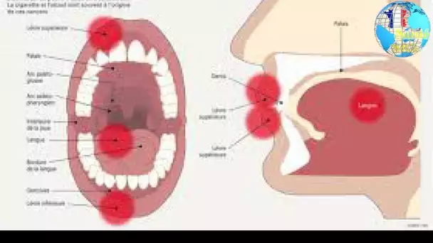 Traitement cancer de la bouche