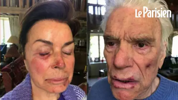 Les Tapie dévoilent des photos de leurs visages après l’agression dont ils ont été victimes