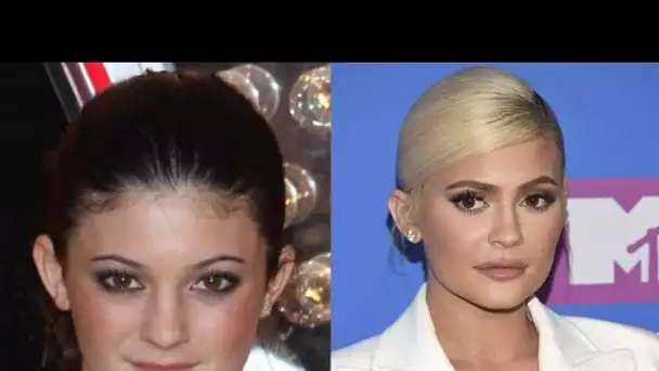 Ces célébrités avant et après les opérations de chirurgie esthétique !