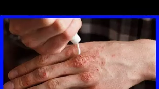 Appliquez ces crèmes naturelles sur la peau et dites adieu au psoriasis !