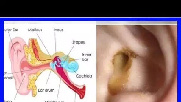 CECI guérit une oreille infectée en 24 heures ! Cette recette est unique et c’est le meilleur remèd