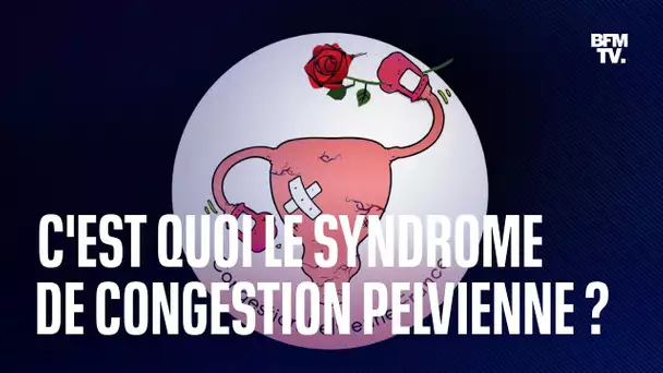 Qu’est-ce que le syndrome de congestion pelvienne, souvent confondu avec l’endométriose ?