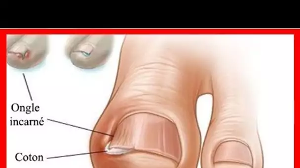 Comment traiter un ongle incarné (traitement maison)