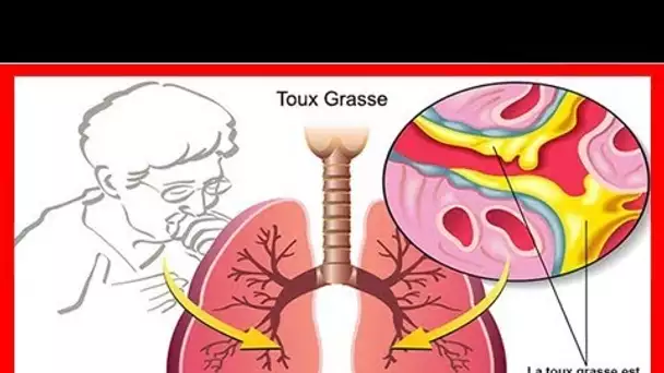 Les meilleurs remèdes naturels contre la toux grasse