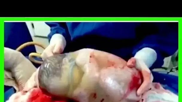 A VOIR ABSOLUMENT: UN MOMENT RARE OU UN BÉBÉ EST NÉ À L’INTÉRIEUR D’UN SAC AMNIOTIQUE INTACT