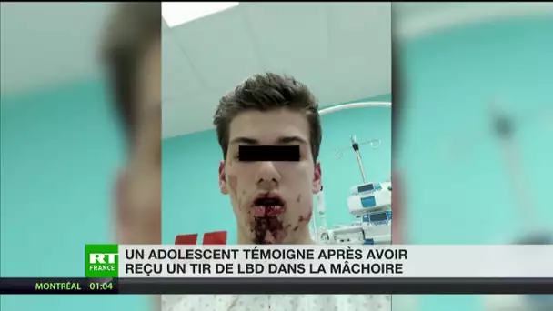 Lyon : le témoignage d’un adolescent victime d’un tir de LBD dans la mâchoire