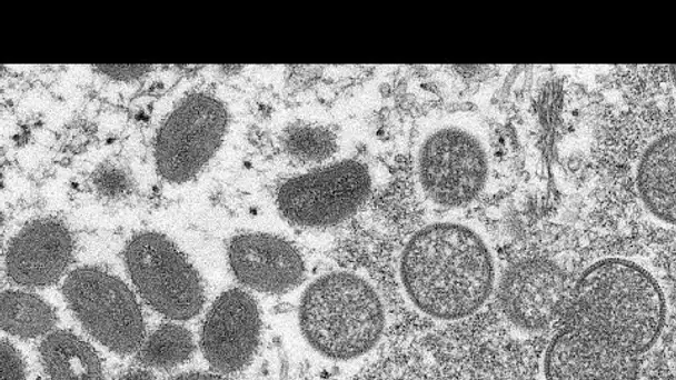 La variole du singe fait son apparition en Europe et Amérique du Nord
