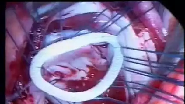 Vidéo chirurgie coeur