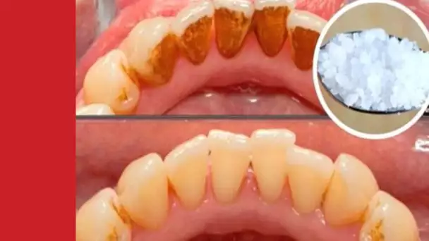 Recette de Grands mère : Voici comment blanchir des dents jaunes naturellement