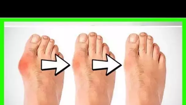 Voici comment se débarrasser des oignons de pieds naturellement!