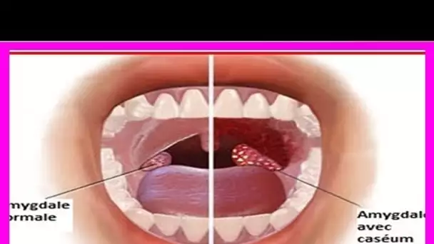 Avec cette Astuce, Débarrassez-vous facilement des petites boules blanches au fond de la gorge