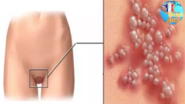 Papillomavirus et cancer : des liaisons dangereuses