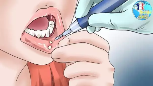 symptômes Cancer de la bouche