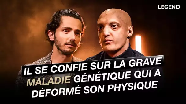 Il se confie sur la grave maladie génétique qui a déformé son physique.