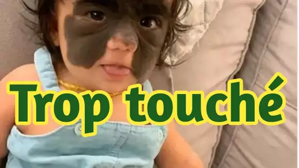 Une petite fille nait avec un « masque de Batman » sur une partie de son visage: