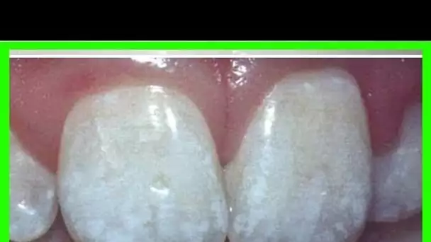 Les taches blanches sur les dents doivent être prises au sérieux et voici pourquoi …