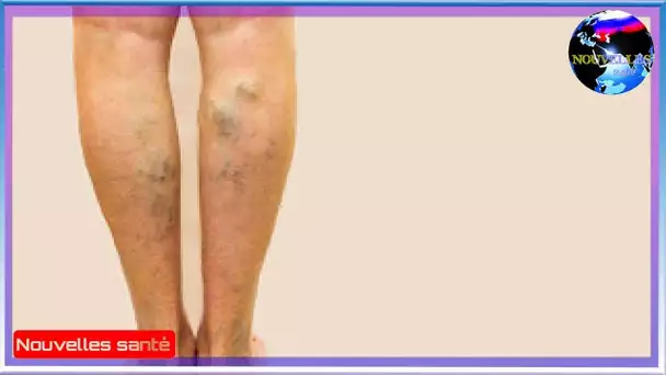 Remede de grand mere contre les varices | NOUVELLES 24H