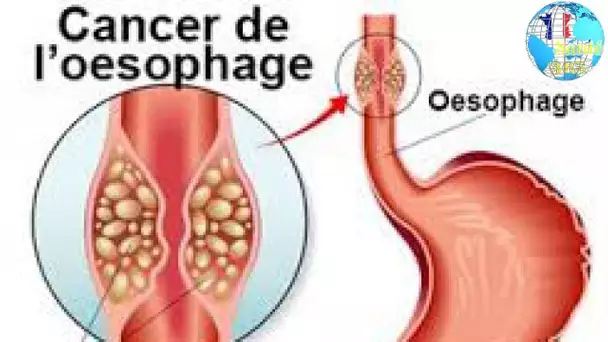 Cancer de l’œsophage traitement