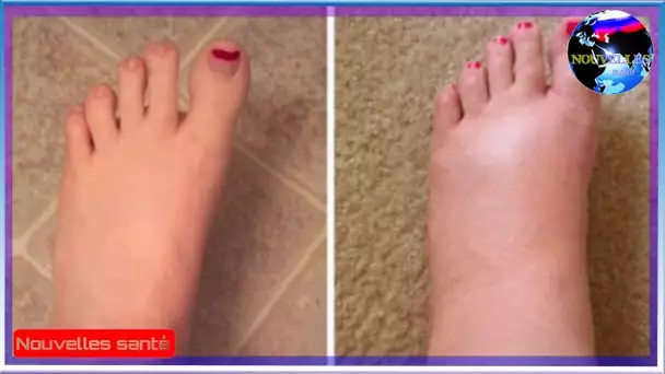 Si vous avez les pieds gonflés à cause de la chaleur, ces 4 astuces peuvent changer votre vie