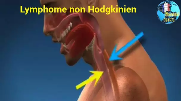 Lymphome non Hodgkinien