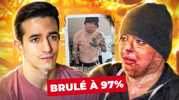 Brûlé à 97% : il racconte son terrible accident