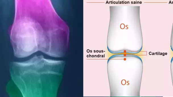 Comment soigner et régénérer le cartilage du genou naturellement