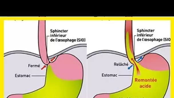 25 remèdes naturels pour traiter le reflux gastro-oesophagien