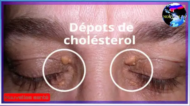 Le moyen d&#039;éliminer les dépôts de cholestérol autour des yeux simplement