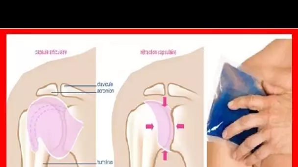 DES TECHNIQUES Surprenantes pour soigner une épaule gelée … Une alternative naturelle à tenter ABSO