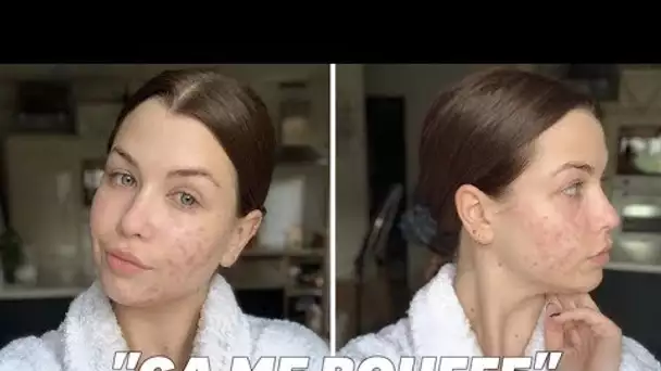 EnjoyPhoenix se dévoile sans maquillage pour parler de son acné hormonale