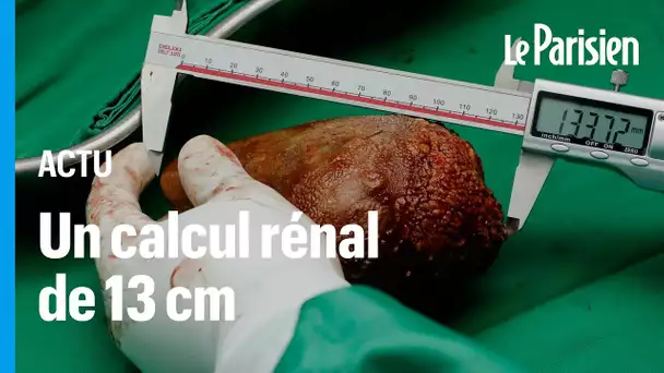 Le plus gros calcul rénal du monde retiré sur un militaire au Sri Lanka