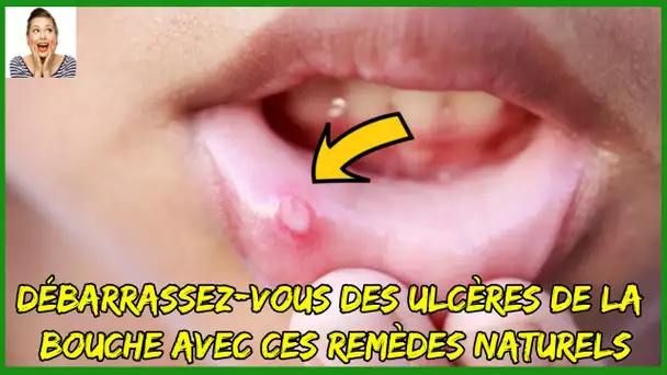 Débarrassez vous des ulcères de la bouche “Les aphtes” avec ces remèdes naturels