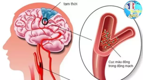 Méningites et contagion : comment est-on infecté ?