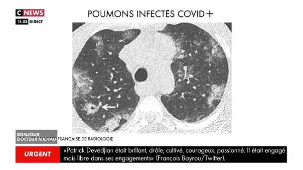 Le docteur Milhau dévoile des images inédites de poumons atteints par le Covid-19
