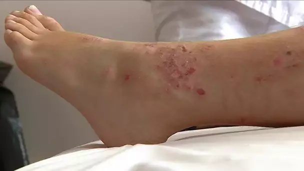 La dermatite atopique au coeur d'une étude clinique au CHU de Nice