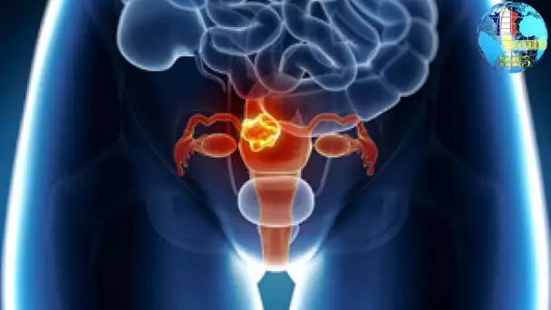 Cancer du col de l’utérus : les moyens de prévention