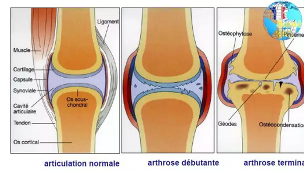 Arthrose du genou : la chirurgie inutile ?