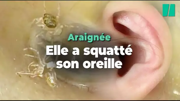 Cette araignée est restée quatre jours dans l'oreille d'une femme