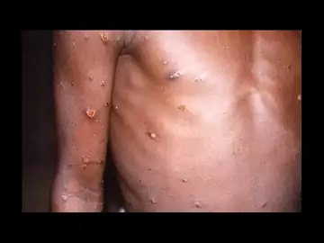 "Variole du singe" : l'OMS juge possible d'arrêter la transmission entre humains