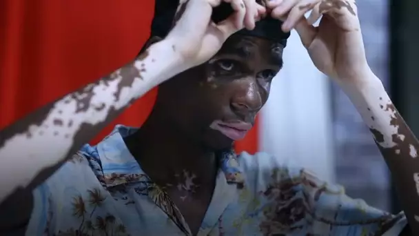 Ce mannequin nous prouve que le vitiligo n'est pas un problème