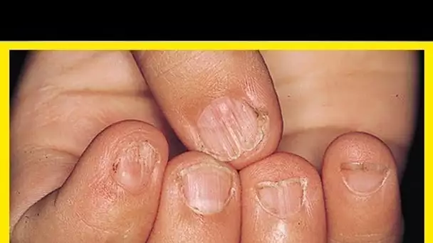 Avertissement ! Vos ongles pourraient indiquer quelques maladies…Voici 5 symptômes à ne jamais igno