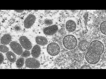 La variole du singe fait son apparition en Europe et Amérique du Nord
